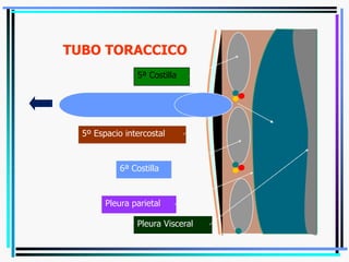 5º Espacio intercostal
5ª Costilla
6ª Costilla
Pleura parietal
Pleura Visceral
TUBO TORACCICO
 