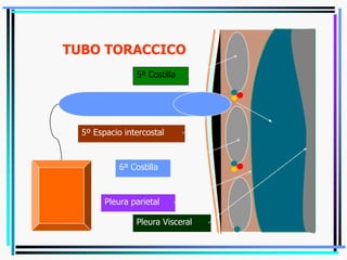 5º Espacio intercostal
5ª Costilla
6ª Costilla
Pleura parietal
Pleura Visceral
TUBO TORACCICO
 