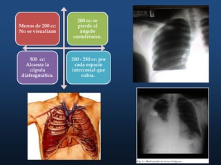 Menos de 200 cc:
No se visualizan
200 cc: se
pierde al
ángulo
costofrénico.
500 cc:
Alcanza la
cúpula
diafragmática.
200 - 250 cc: por
cada espacio
intercostal que
cubra.
 