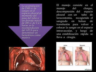 • La acumulación
de 1500 cc de
sangre en el
espacio pleural al
momento del
paso del tubo o
un drenaje mayor
de 200 cc de 2 a 4
horas, es la
recomendación
del ATLS para
denominar un
hemotórax como
masivo.
El manejo consiste en el
manejo del choque,
descompresión del espacio
pleural con un tubo de
toracostomia, recogiendo el
sangrado en bolsas de
transfusión para volver a
colocar la sangre en el espacio
intravascular, y luego de
una estabilización rápida se
lleva a cirugía.
 