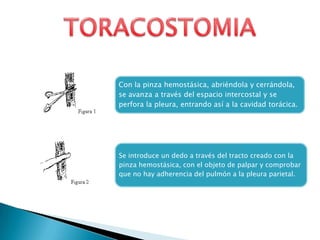 Con la pinza hemostásica, abriéndola y cerrándola,
se avanza a través del espacio intercostal y se
perfora la pleura, entrando así a la cavidad torácica.
Se introduce un dedo a través del tracto creado con la
pinza hemostásica, con el objeto de palpar y comprobar
que no hay adherencia del pulmón a la pleura parietal.
 