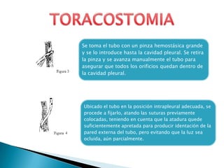 Se toma el tubo con un pinza hemostásica grande
y se lo introduce hasta la cavidad pleural. Se retira
la pinza y se avanza manualmente el tubo para
asegurar que todos los orificios quedan dentro de
la cavidad pleural.
Ubicado el tubo en la posición intrapleural adecuada, se
procede a fijarlo, atando las suturas previamente
colocadas, teniendo en cuenta que la atadura quede
suficientemente apretada para producir identación de la
pared externa del tubo, pero evitando que la luz sea
ocluida, aún parcialmente.
 