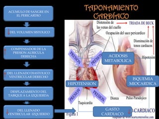 ACUMULO DE SANGRE EN
EL PERICARDIO
COMPENSADOR DE LA
PRESION AURICULA
DERECHA
DEL LLENADO DIASTOLICO
VENTRICULAR DERECHO
DEL VOLUMEN SISTOLICO
DESPLAZAMIENTO DEL
TABIQUE A LA IZQUIERDA
DEL LLENADO
VENTRICULAR IZQUIERDO
GASTO
CARDIACO
HIPOTENSION
ACIDOSIS
METABOLICA
ISQUEMIA
MIOCARDICA
TAPONAMIENTO
CARDÍACO
 