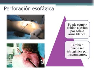 Perforación esofágica
Puede ocurrir
debido a lesión
por bala o
arma blanca.
También
puede ser
iatrogénica por
instrumentos.
 