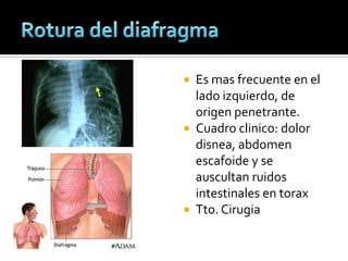  Es mas frecuente en el
lado izquierdo, de
origen penetrante.
 Cuadro clinico: dolor
disnea, abdomen
escafoide y se
auscultan ruidos
intestinales en torax
 Tto. Cirugia
 