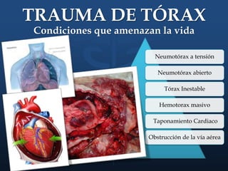 TRAUMA DE TÓRAX
Condiciones que amenazan la vida
Neumotórax a tensión
Neumotórax abierto
Tórax Inestable
Hemotorax masivo
Taponamiento Cardiaco
Obstrucción de la vía aérea
 