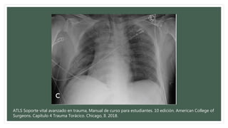 ATLS Soporte vital avanzado en trauma, Manual de curso para estudiantes. 10 edición. American College of
Surgeons. Capítulo 4 Trauma Torácico. Chicago, Il. 2018.
 