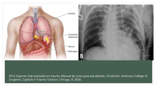ATLS Soporte vital avanzado en trauma, Manual de curso para estudiantes. 10 edición. American College of
Surgeons. Capítulo 4 Trauma Torácico. Chicago, Il. 2018.
 