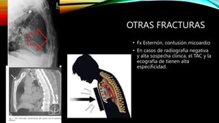 OTRAS FRACTURAS
• Fx Esternón, contusión micoardio
• En casos de radiografía negativa
y alta sospecha clínica, el TAC y la
ecografía de tienen alta
especificidad.
 