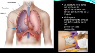 • La abertura en la pared
del pecho es de
aproximadamente dos
tercios del diámetro de la
tráquea
• el aire pasa
preferentemente a través
del defecto de la pared
del
pecho con cada
inspiración
 