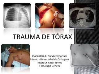 Jhonnattan E. Narváez Chartuni
Interno - Universidad de Cartagena
      Tutor: Dr. Cesar Torres
        R III Cirugía General
 