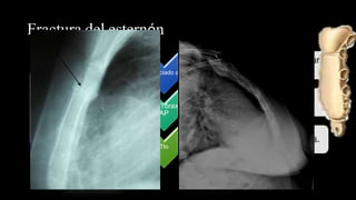 Fractura del esternón
DX:
Antecedente
de trauma,
dolor en
área pre-
esternal.
Confirmar:
RX de tórax
en
proyección
lateral.
Asociado a
• Contusiones cardíacas, ruptura
aorta y traqueobronquiales.
Rx Tórax
AP
• Imagen de hemomediastino.
Tto
• 1)Analgesia. 2) Osteosíntesis.
 