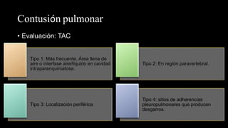 Contusión pulmonar
• Evaluación: TAC
Tipo 1: Más frecuente. Área llena de
aire o interfase aire/líquido en cavidad
intraparenquimatosa.
Tipo 2: En región paravertebral.
Tipo 3: Localización periférica
Tipo 4: sitios de adherencias
pleuropulmonares que producen
desgarros.
 