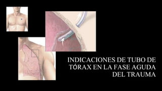 INDICACIONES DE TUBO DE
TÓRAX EN LA FASE AGUDA
DEL TRAUMA
 