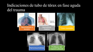 Indicaciones de tubo de tórax en fase aguda
del trauma
Neumotórax a
tensión
Hemotórax
masivo
Tórax inestable
Hemoneumotórax
Profilaxis del
espacio pleural
 