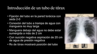 Introducción de un tubo de tórax
• Fijación del tubo en la pared torácica con
seda 2-0
• Conexión del tubo a trampa de agua con
manguera no muy larga
• Manguera debajo del agua no debe estar
sumergida a más de 2 cm
• Con succión negativa aspiración de 20 cm
de agua de presión negativa
• Rx de tórax mostrará posición del tubo
 
