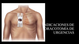 INDICACIONES DE
TORACOTOMÍA DE
URGENCIAS
 