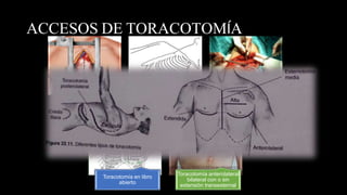 ACCESOS DE TORACOTOMÍA
Esternotomía media Toracotomía anterolateral
Toracotomía
posterolateral
Toracotomía en libro
abierto
Toracotomía anterolateral
bilateral con o sin
extensión transesternal
 