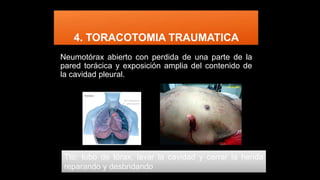 4. TORACOTOMIA TRAUMATICA
Neumotórax abierto con perdida de una parte de la
pared torácica y exposición amplia del contenido de
la cavidad pleural.
Tto: tubo de tórax, lavar la cavidad y cerrar la herida
reparando y desbridando
 