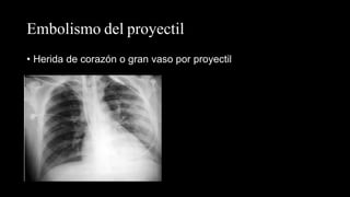 Embolismo del proyectil
• Herida de corazón o gran vaso por proyectil
 