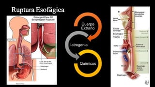 Ruptura Esofágica
Cuerpo
Extraño
Iatrogenia
Quimicos
 