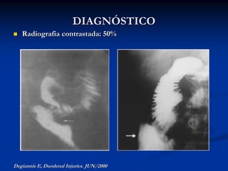 DIAGNÓSTICO
   Radiografia contrastada: 50%




Degiannis E, Duodenal Injuries. JUN/2000
 