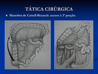 TÁTICA CIRÚRGICA
Manobra de Cattell-Braasch: acesso à 3ª porção.
 