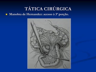 TÁTICA CIRÚRGICA
Manobra de Hernandez: acesso à 3ª porção.
 