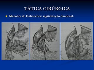 TÁTICA CIRÚRGICA
Manobra de Duboucher: sagitalização duodenal.
 