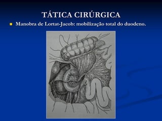 TÁTICA CIRÚRGICA
Manobra de Lortat-Jacob: mobilização total do duodeno.
 
