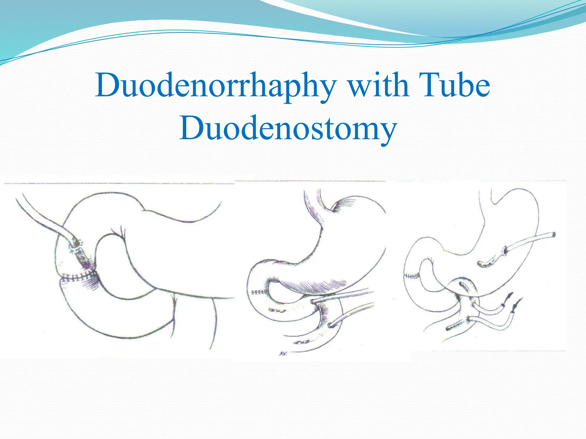 Diagnostico Y Manejo Del Trauma Duodenal pptx diagnostico-y-manejo-del-trauma-duodenal-pptx