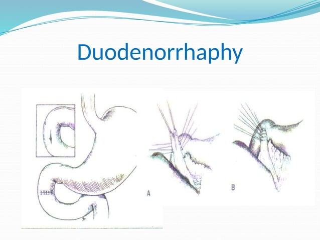 Diagnostico Y Manejo Del Trauma Duodenal pptx diagnostico-y-manejo-del-trauma-duodenal-pptx