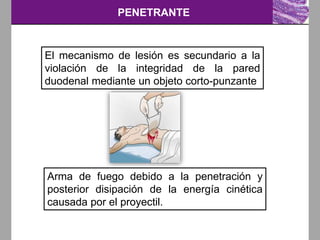 PENETRANTE
El mecanismo de lesión es secundario a la
violación de la integridad de la pared
duodenal mediante un objeto corto-punzante
Arma de fuego debido a la penetración y
posterior disipación de la energía cinética
causada por el proyectil.
 