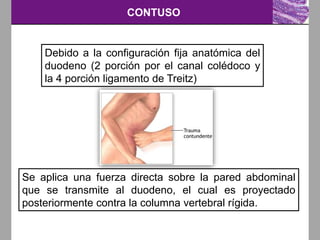 CONTUSO
Debido a la configuración fija anatómica del
duodeno (2 porción por el canal colédoco y
la 4 porción ligamento de Treitz)
Se aplica una fuerza directa sobre la pared abdominal
que se transmite al duodeno, el cual es proyectado
posteriormente contra la columna vertebral rígida.
 