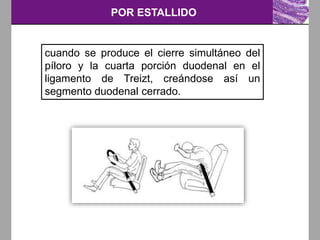 POR ESTALLIDO
cuando se produce el cierre simultáneo del
píloro y la cuarta porción duodenal en el
ligamento de Treizt, creándose así un
segmento duodenal cerrado.
 