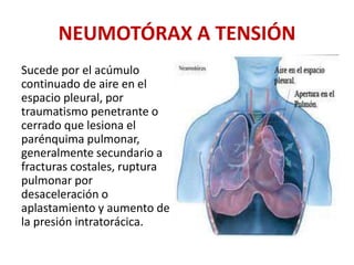 NEUMOTÓRAX A TENSIÓN
Sucede por el acúmulo
continuado de aire en el
espacio pleural, por
traumatismo penetrante o
cerrado que lesiona el
parénquima pulmonar,
generalmente secundario a
fracturas costales, ruptura
pulmonar por
desaceleración o
aplastamiento y aumento de
la presión intratorácica.
 