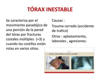 TÓRAX INESTABLE
Se caracteriza por el
movimiento paradójico de
una porción de la pared
del tórax por fracturas
costales múltiples (+3) y
cuando las costillas están
rotas en varios sitios.
Causas :
Trauma cerrado (accidente
de trafico)
Otras : aplastamiento,
laborales , agresiones.
 
