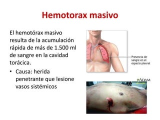 Hemotorax masivo
El hemotórax masivo
resulta de la acumulación
rápida de más de 1.500 ml
de sangre en la cavidad
torácica.
• Causa: herida
penetrante que lesione
vasos sistémicos
 
