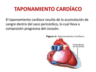 TAPONAMIENTO CARDÍACO
El taponamiento cardíaco resulta de la acumulación de
sangre dentro del saco pericárdico, lo cual lleva a
compresión progresiva del corazón.
 