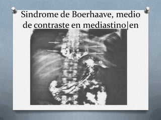 Sindrome de Boerhaave, medio
de contraste en mediastino|en
SGD
 