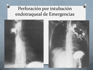 Perforación por intubación
endotraqueal de Emergencias
 