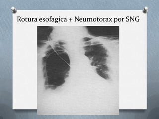 Rotura esofagica + Neumotorax por SNG
 