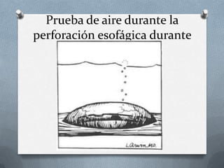 Prueba de aire durante la
perforación esofágica durante
la esofamiotomía
 