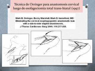 Técnica de Orringer para anastomosis cervical
luego de esofagectomía total trans-hiatal (1997)
 