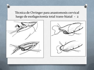 Técnica de Orringer para anastomosis cervical
luego de esofagectomía total trans-hiatal - 2
 