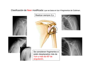Clasificación de Neer modificada: que se basa en los 4 fragmentos de Coldman.
Se consideran fragmentos si
están desplazados más de
1cm o más de 45º de
angulación.
Realizar siempre 2 p
 