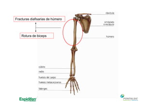 Fracturas diafisarias de húmero
Rotura de biceps
 