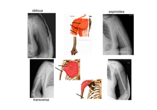 oblicua espiroidea
transversa
 