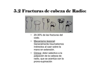 5.2 Fracturas de cabeza de Radio:
• 20-30% de las fracturas del
codo.
• Mecanismo lesional:
Generalmente traumatismos
indirectos al caer sobre la
mano en extensión.
• Clínica: dolor selectivo a la
palpación de la cabeza de
radio, que se acentúa con la
prono-supinación
 