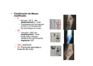 • Clasificación de Mason
modificada:
– I:
• Parcelar <30 % , sin
desplazamiento o < 2mm.
• Pronosupinación limitada por
el dolor y la tumefacción.
• No hay bloqueo articular.
– II:
• Parcelar > 30% con
desplazamiento > 2mm.
• Puede haber bloqueo
mecánico de la articulación.
• Angulación >30º.
– III: conminuta.
– IV: Fracturas asociadas a
luxación del codo.
 